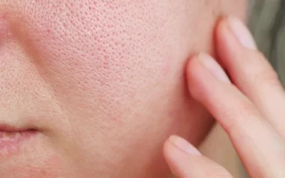 Enlarged PORES is bothering you ?